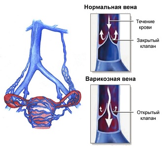 Апоплексия при варикозном расширении вен