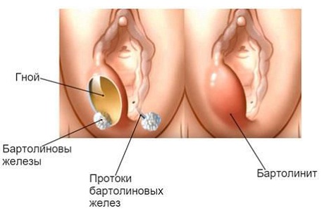 Бартолинит у женщин