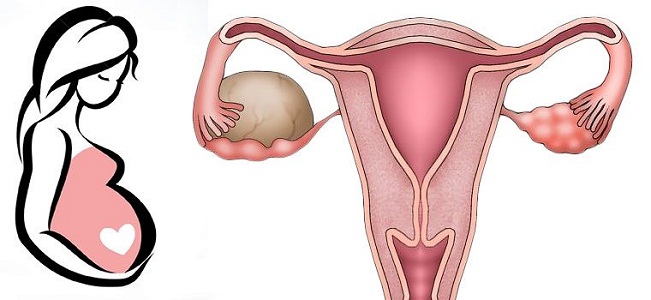 Беременность при кисте яичника