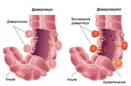 Болит бок перед месячными при дивертикулите