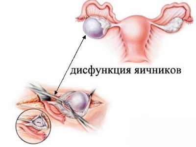 Болит кишечник при дисфункции яичников