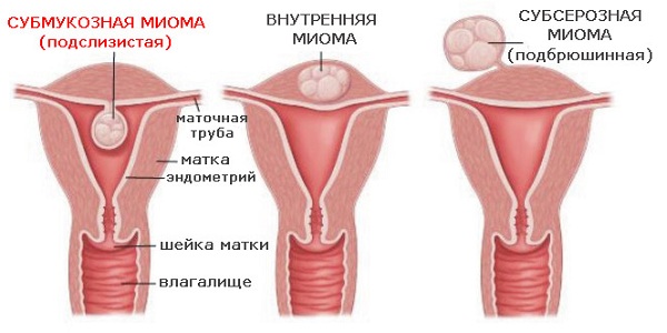 Болит бок перед месячными при миоме