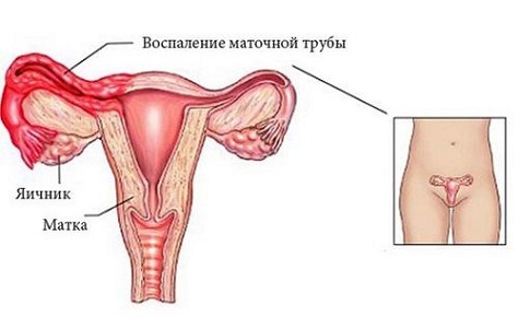 Болит живот во время месячных при аднексите