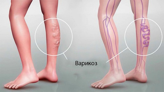 Болят ноги перед месячными при варикозе