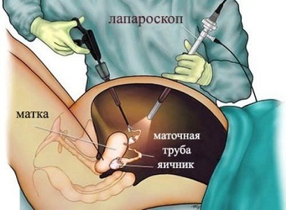 Диагностика апоплексии