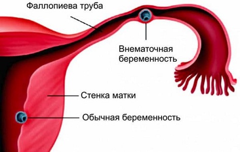 Экстренное УЗИ во время месячных