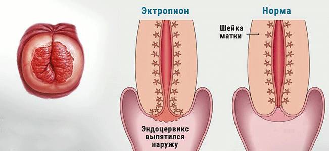 Эктропион шейки матки