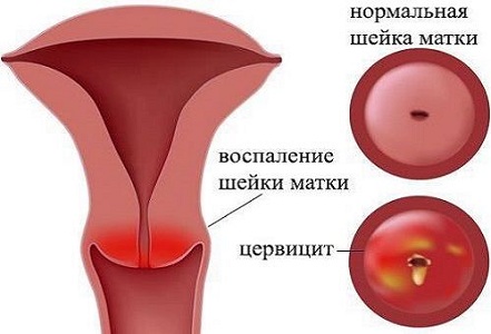 Осложнения после эктропиона шейки матки