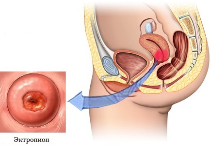 Эктропион шейки матки
