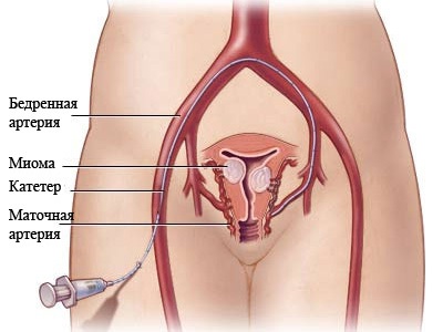 Эмболизация маточных артерий при миоме во время беременности