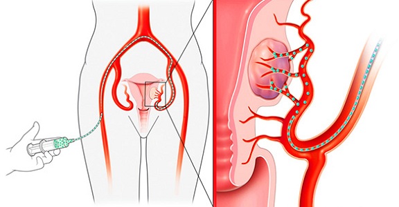 Эмболизация миомы матки