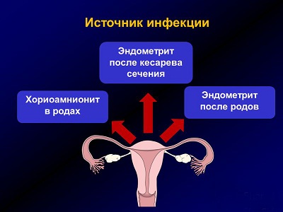 Эндометрит у женщин после кесарева