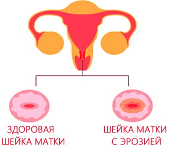 Эрозия шейки матки у женщин