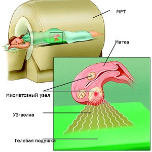 ФУЗ-абляция миомы матки