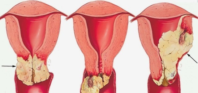 Формы аденокарциномы матки