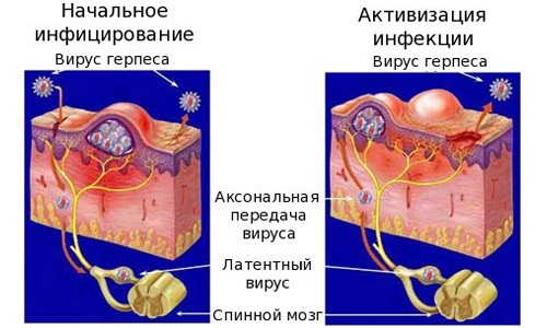 Формы генитального герпеса у женщин