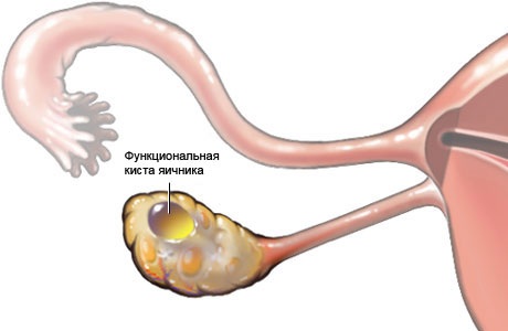 Функциональная киста яичника во время месячных