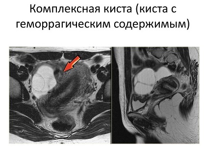 Геморрагическая киста яичника