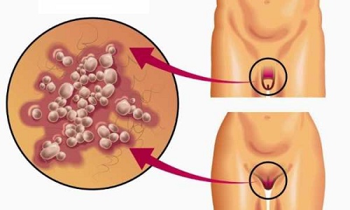 Герпес на половых органах и месячные