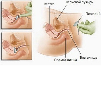 Гинекологическое кольцо при опущении матки