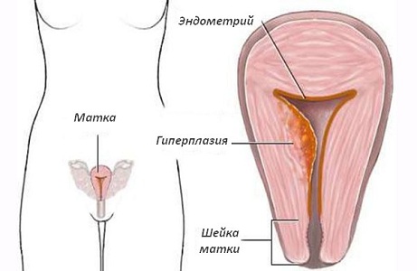 Гипоменорея при гиперплазии эндометрия