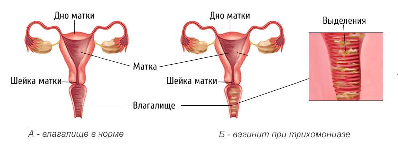 Гнойные выделения при онкологии