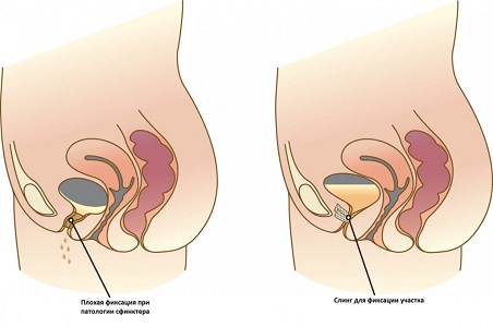Хирургический метод лечения недержания мочи