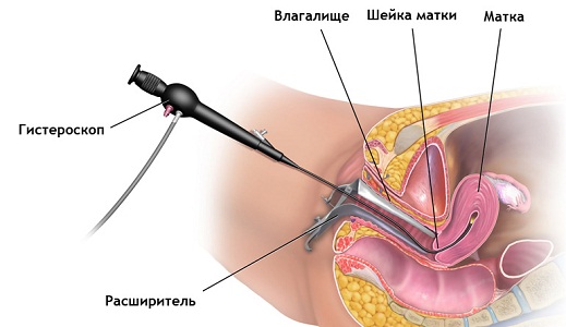 Хирургическое удаление полипа эндометрия