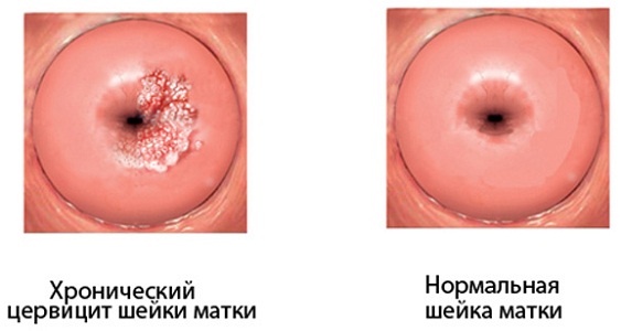 Хронический цервицит