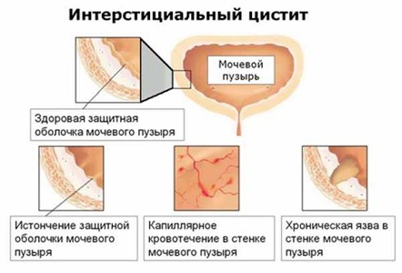 Интерстициальный цистит при климаксе