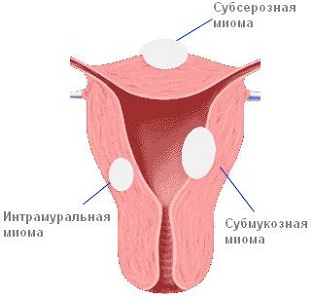 Интрамуральная миома матки