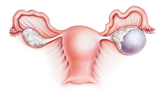 Киста яичника во время климакса