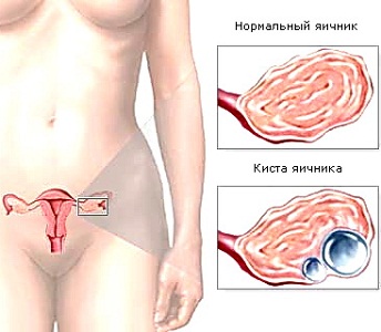 Гормональная киста яичника