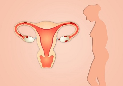 Классификация эндометрита у женщин