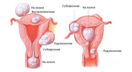 Классификация фибромиомы матки