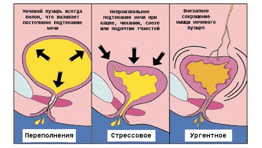 Классификация недержания мочи во время климакса