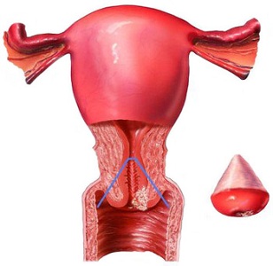 Конизация шейки матки