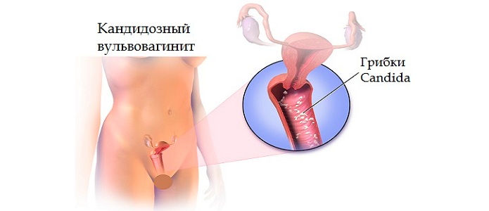 Коричневые выделения при вульвовагините