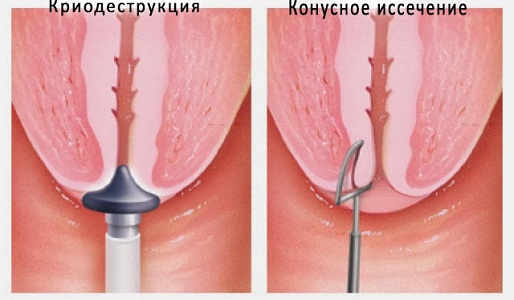 Криодеструкция шейки матки