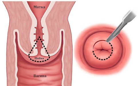 Круговая биопсия шейки матки