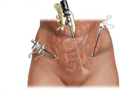 Лапароскопия при эндометриозе