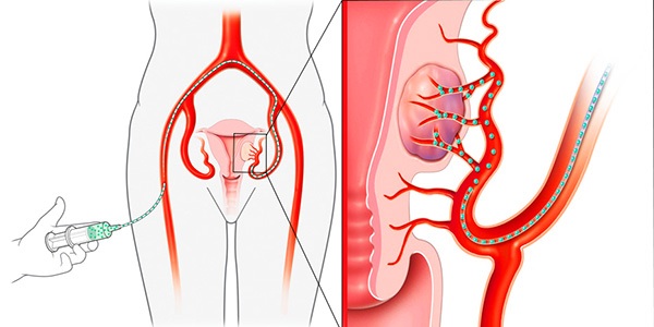 Лечение фибромиомы матки