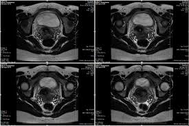 МРТ органов малого таза во время месячных