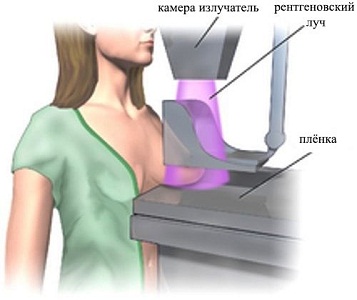 Облучение при маммографии