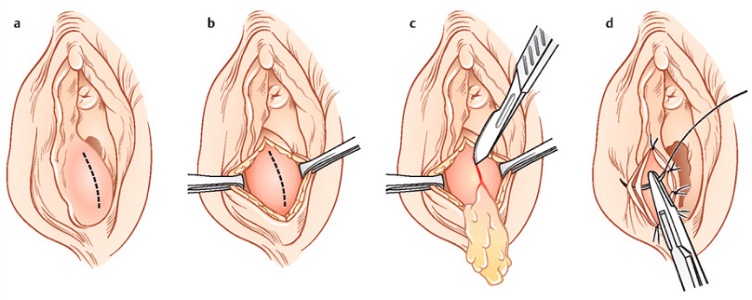 Марсупиализация кисты бартолиновой железы