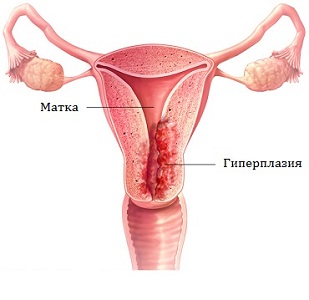 Месячные при гиперплазии