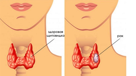 Месячные при раке щитовидной железы