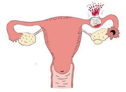 Месячные пришли раньше из-за внематочной беременности