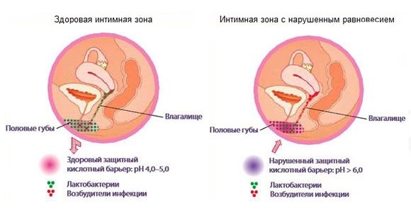 Минусы применения свечей от молочницы