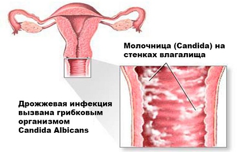 Молочница на ранних сроках беременности